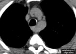 Aberrant Right subclavian artery